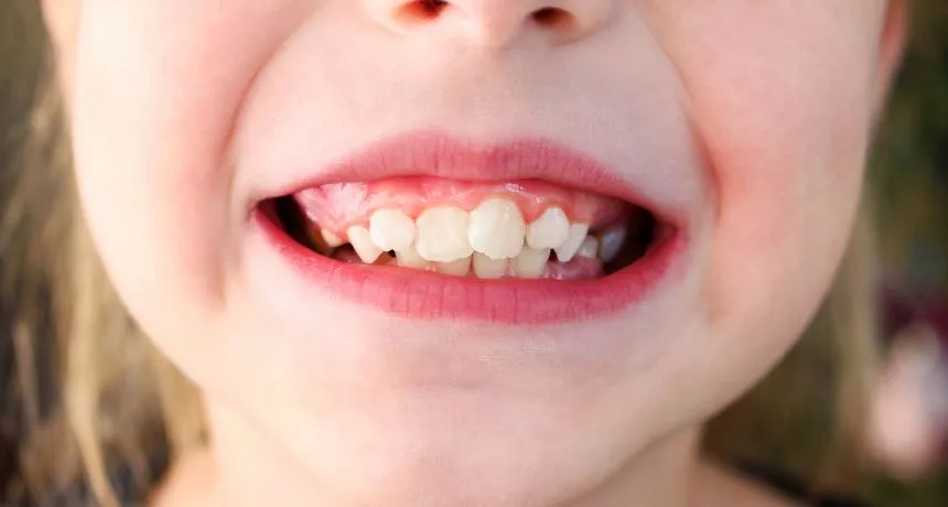 Missing One or More Teeth