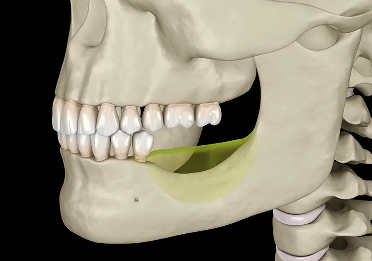 Bone Loss in the Jaw